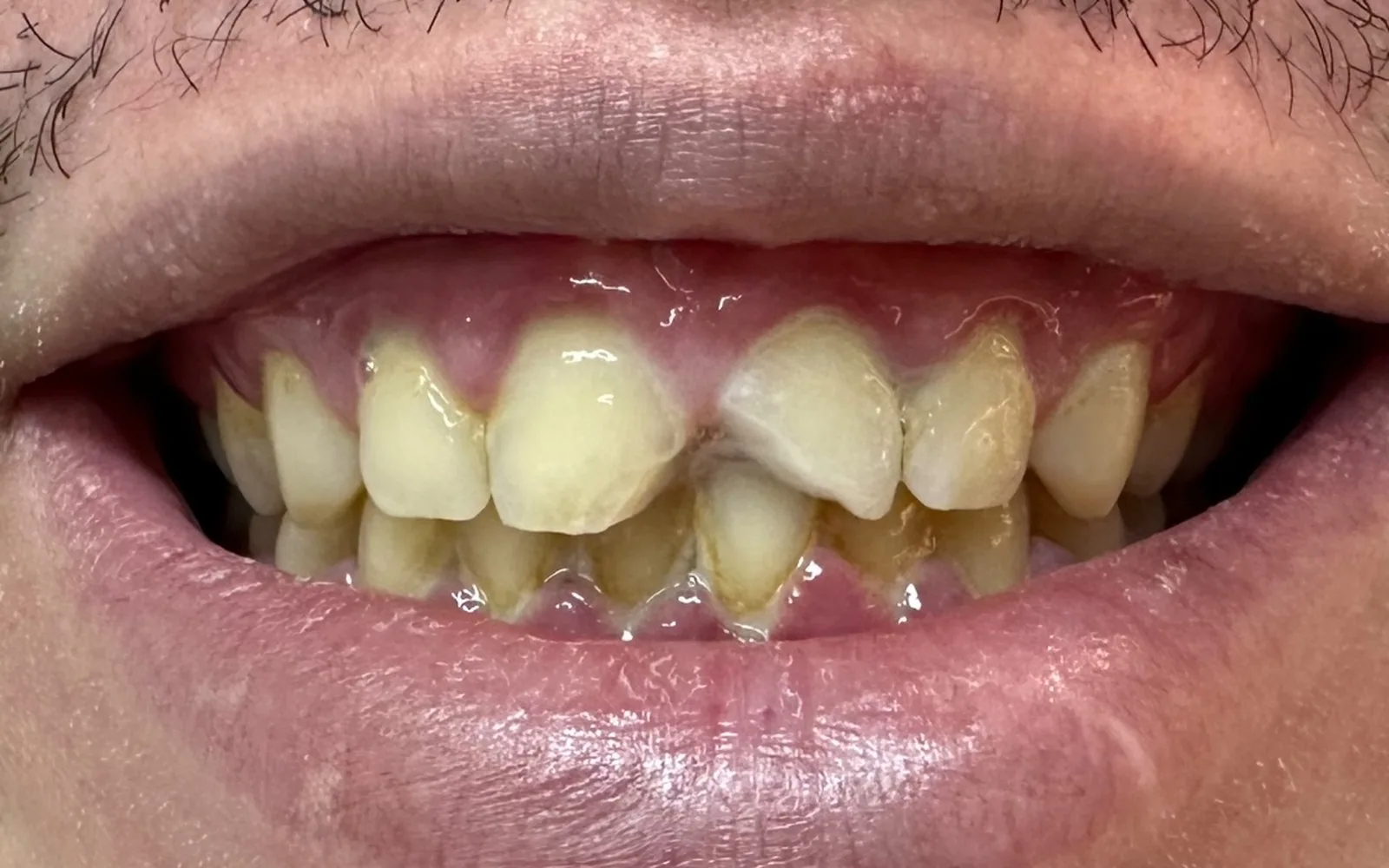 Sorriso do paciente antes do tratamento