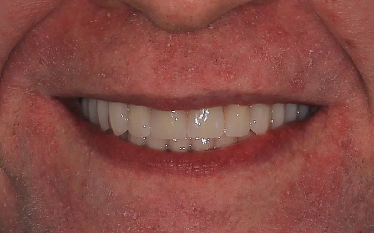 Sorriso do paciente depois do tratamento